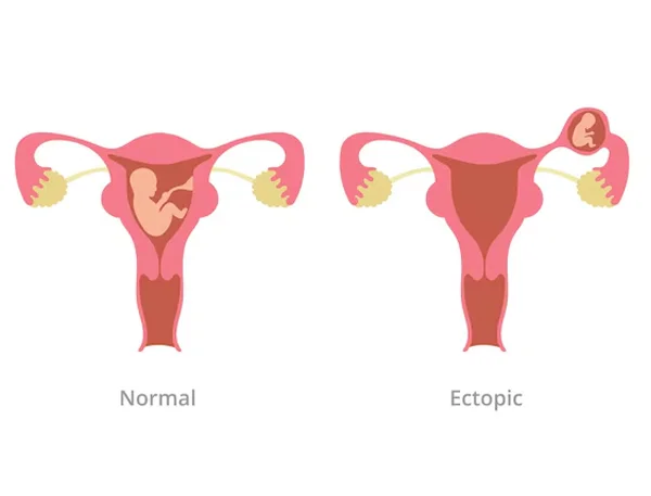 Ectopic Pregnancy