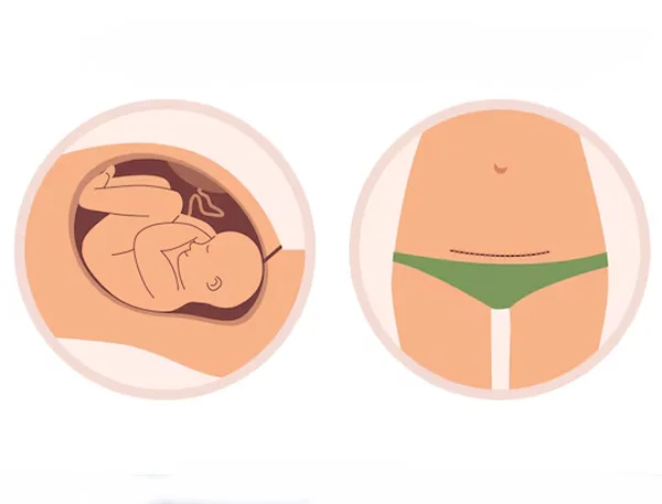 Caesarean Section