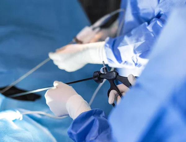 Laparoscopic Hysterectomy