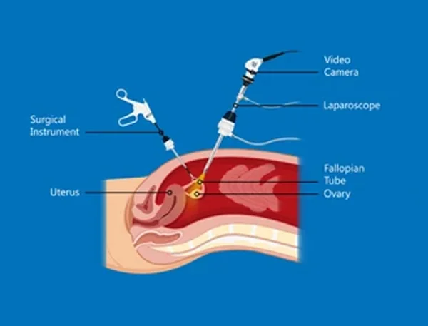 Myomectomy