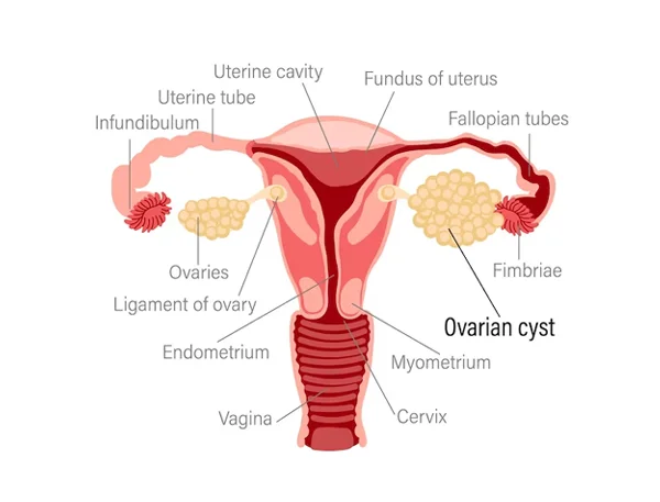 Ovarian Cystectomy